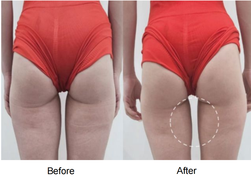 JETIVA 身體緊緻療程前後 — 大腿橘皮淡化、肌膚緊緻