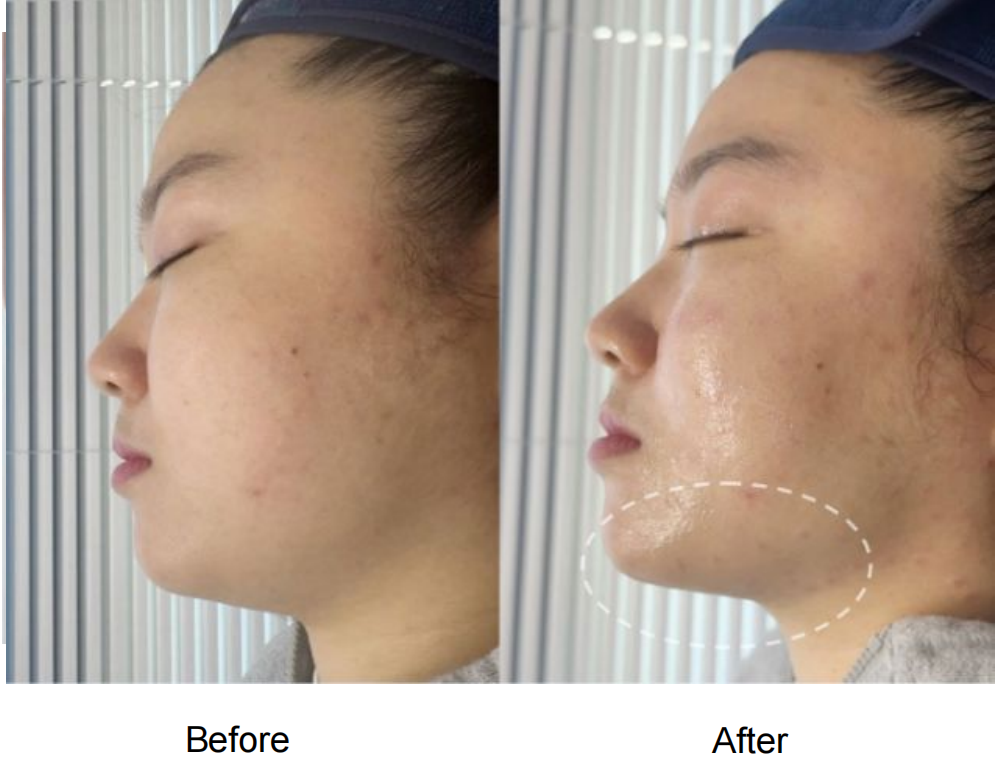 JETIVA 面部療程前後對比 — 暗瘡印淡化、膚色提亮、輪廓緊緻
