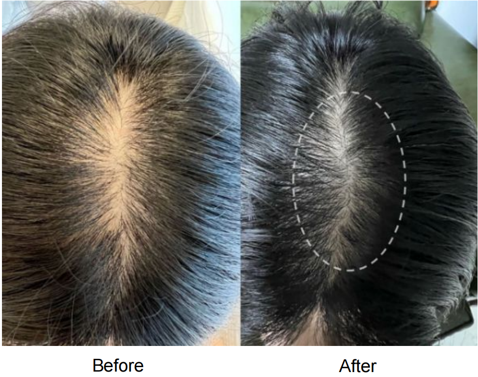 JETIVA 頭皮再生療程前後 — 毛囊活化、髮量明顯增加